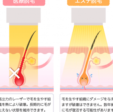 医療脱毛・美容脱毛・脱毛サロン徹底比較！違いとは？
