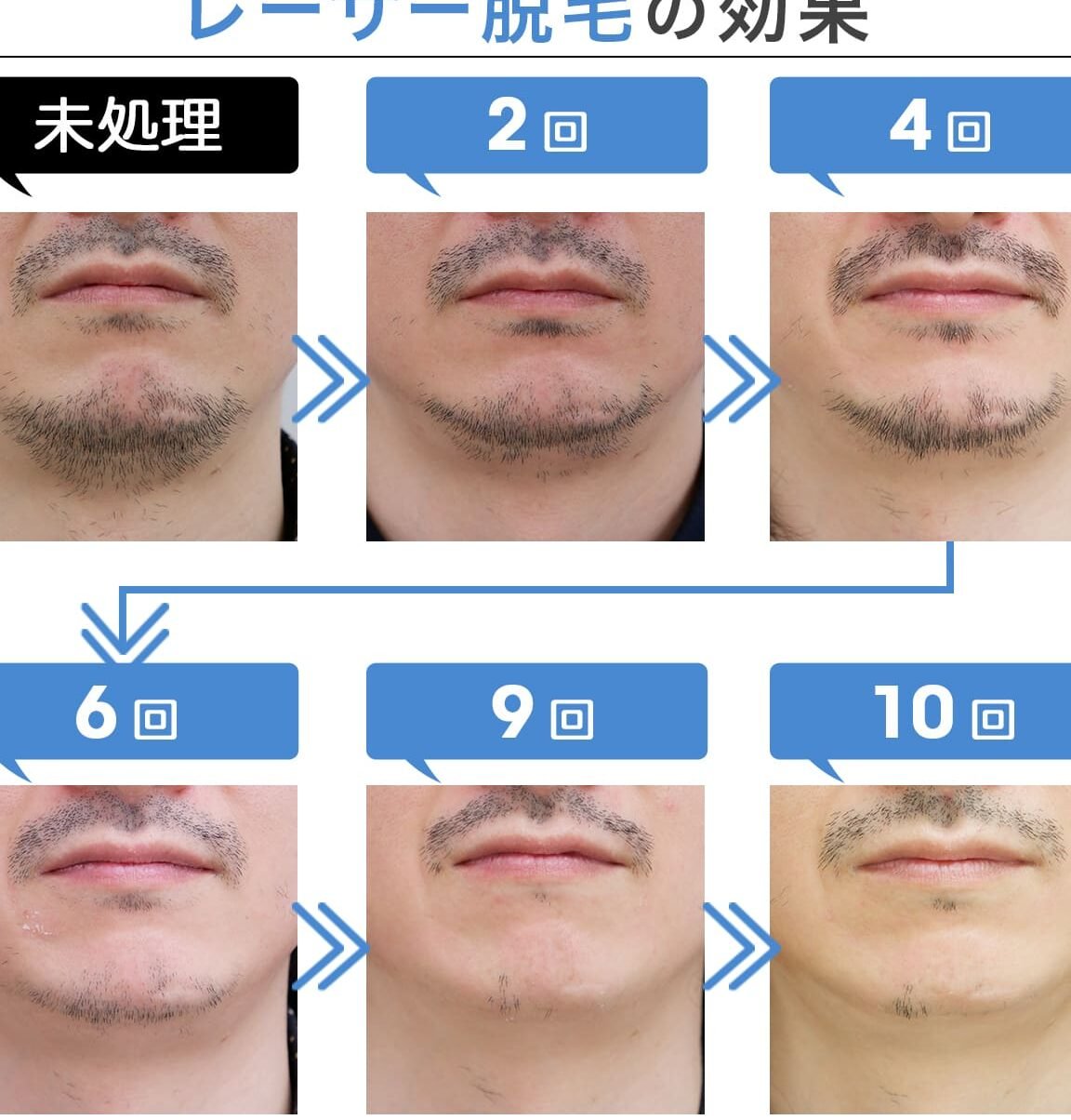 髭脱毛で後悔しない！効果・回数・費用を解説！